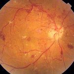 retinopati